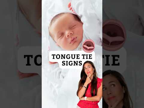 Could Your Baby Have a Tongue Tie? Key Signs to Know!