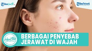 Berbagai Penyebab Muncul Jerawat di Wajah, dari Sumbatan pada Folikel Rambut hingga Stres