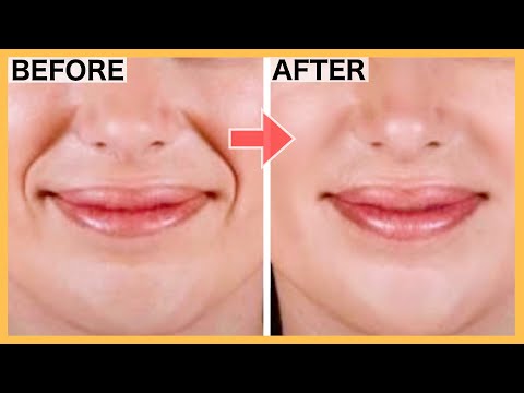 SMILE LINES Facial Exercises (Nasolabial Folds/ Laugh Lines) | Lift Smile Lines with this WORKOUT!