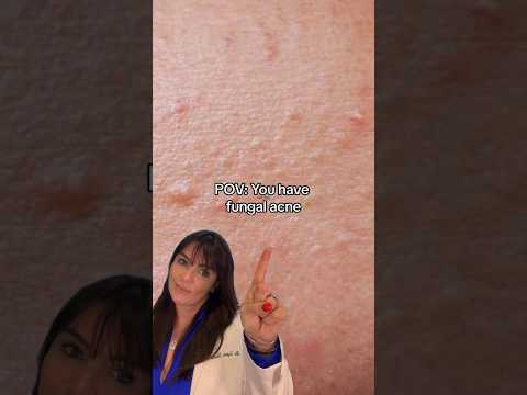 How to effectively tackle fungal acne 👆🏽 #fungalacne #skincarecommunity #acnehelp #acneproneskin