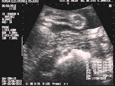 ULTRASONIDO DE SHARON