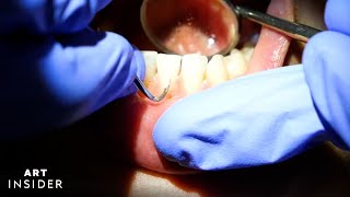 How Buildup Is Satisfyingly Removed From Teeth
