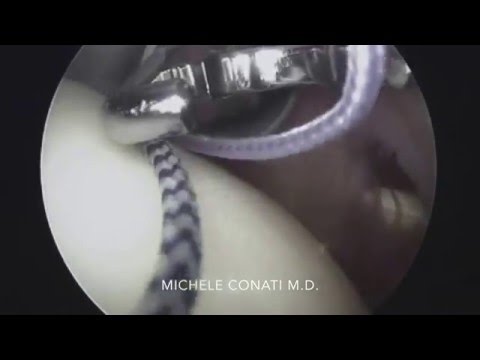 Bike articolazione ginocchio dolente Lupus eritematoso, malattie delle articolazioni