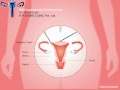 Animation of Total Laparoscopic Hysterectomy
