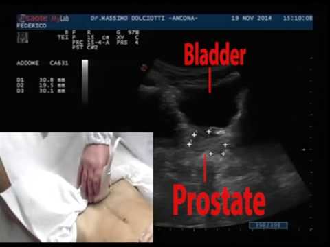 Come trattare il cancro alla prostata nelle fasi iniziali Ciò compresse da bere dopo la rimozione della prostata