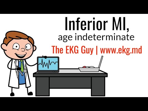 Inferior MI (age indeterminate) on EKG / ECG l The EKG Guy - www.ekg.md