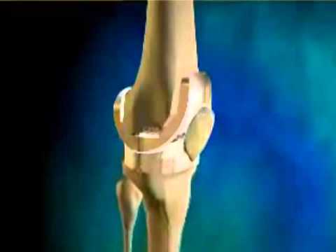 Knee Replacement Surgeon Chennai