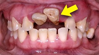 Should you EXTRACT teeth BEFORE getting braces? | Orthodontist EXPLAINS