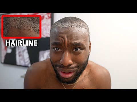 My Hairline Surgery has hit an ALL TIME LOW...