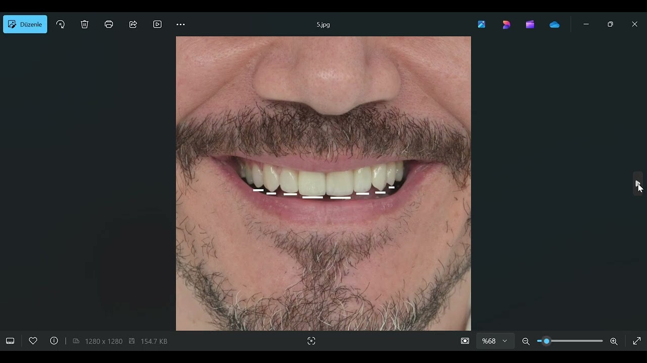 Incisal Line in Smile Design