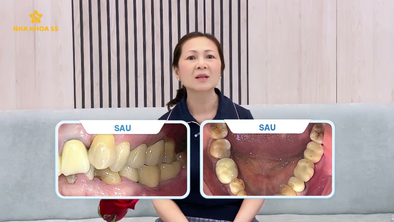 Phục Hình Tháo Lắp – Cải Thiện Thẩm Mỹ Nụ Cười 14