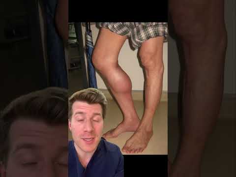 Doctor explains BAKERS CYST in 60 seconds! #shorts #health #medical #doctor