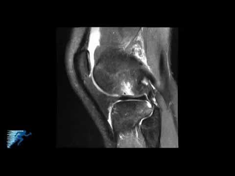 Yoga durante osteocondrosi Giunti immaturi in 2 mesi