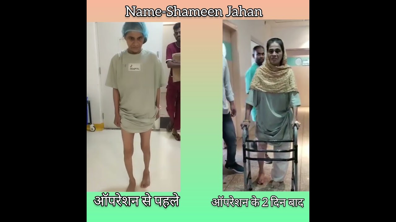Knee Replacement Surgery - pt name Shameen Jahan #kneepain #kneereplacementsurgeon #drtarunsolanki