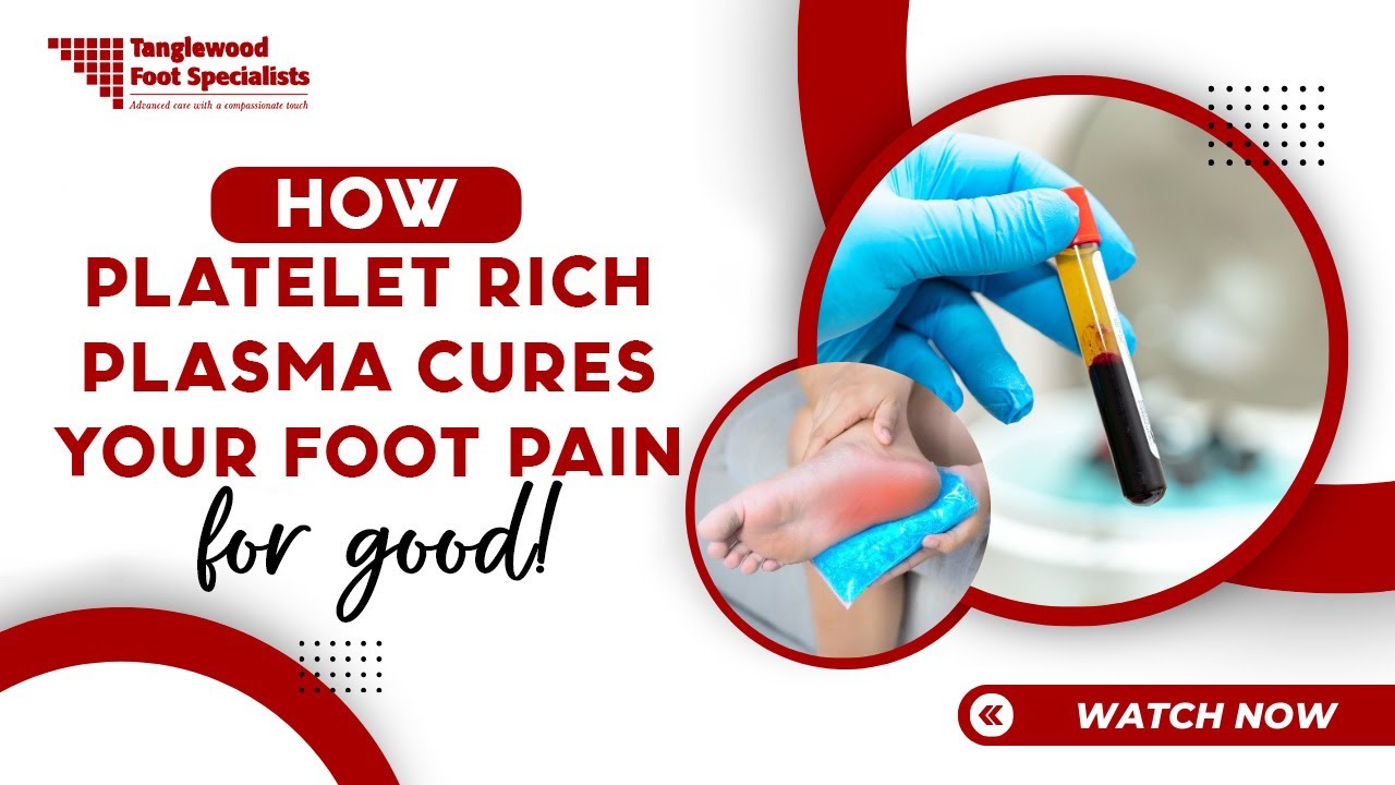 Platelet Rich Plasma (PRP): A Natural Solution for Chronic Foot Pain