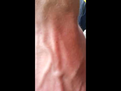 Il carbone aiuta da parassiti Medicina per lyambliya intestinale