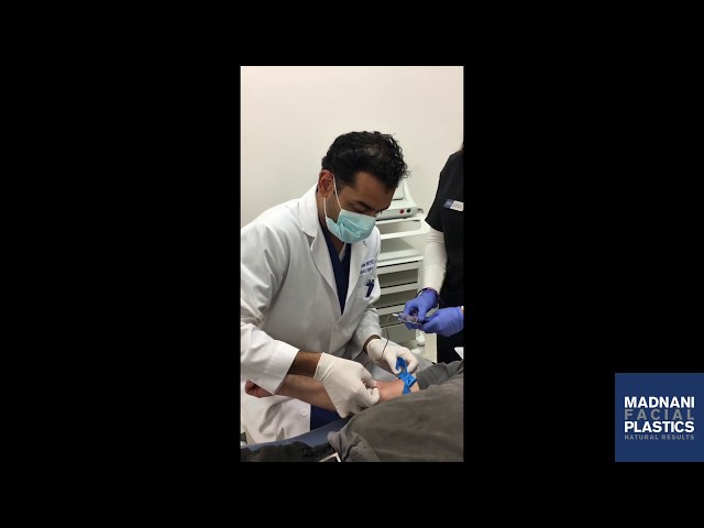 PRP and Microneedling for hair Restoration