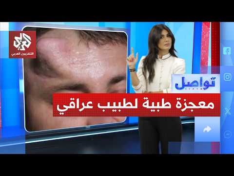  زراعة أنف في رأس بشري