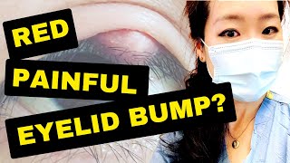 Red and painful EYELID BUMP? | It might be a STYE or a CHALAZION!