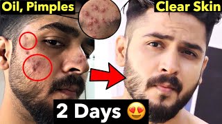 10 Pimple Mistakes | How to Remove Pimples From Face | Remove Acne Naturally