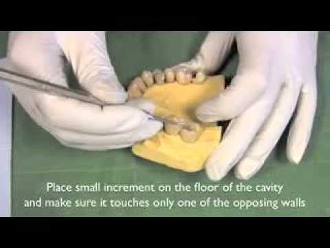 Replacement of Class I Amalgam Restoration with Composite Resin Material