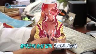 [기획취재] 치루, 어떻게 치료할까?