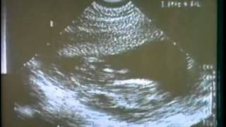 The Silent Scream (Full Length)