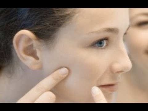 BEST remedies for acne.