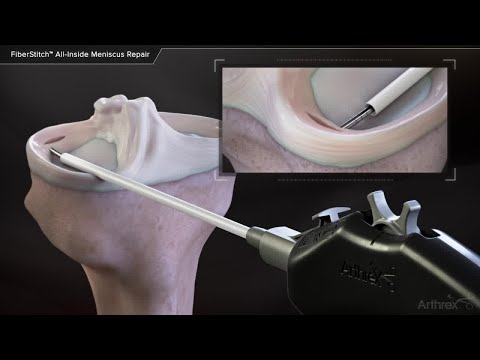 FiberStitch™ All-Inside Meniscus Repair