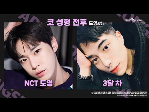  남자 코성형 전후 | 남자 코수술 이렇게 하세요‼