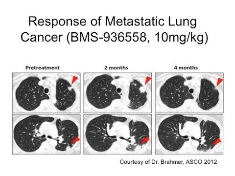 GRACEcast-145_Lung_Highlights in Lung Cancer, 2013: Squamous Cell NSCLC and antiPD1