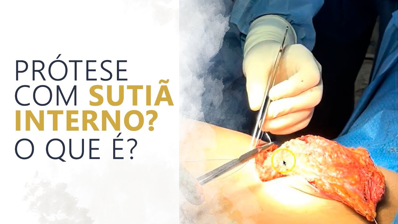 PRÓTESE COM SUTIÃ INTERNO? O QUE É?