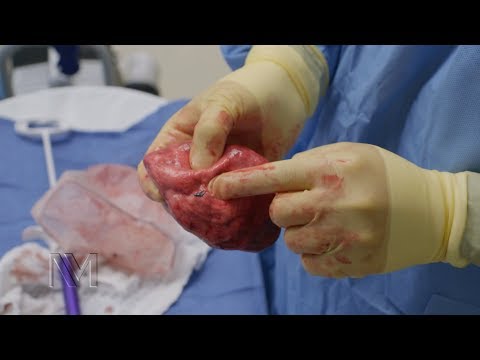 Lung Cancer Inside Dr. Kim's Operating Room