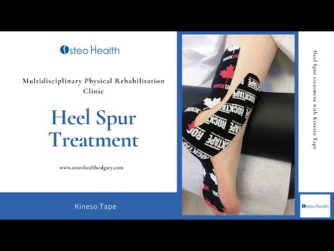 Heel spur treatment with Kinesio Tape