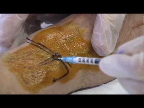 Blocco con osteocondrosi cervicale Trattamento fisio delle ernie della colonna vertebrale