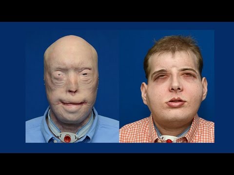 Click to Watch the Miraculous face transplant restores faceless firefighter's faith in life video