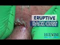 An Eruptive, Massive Back Cyst That Took Us 1.5 Hours | HueVine