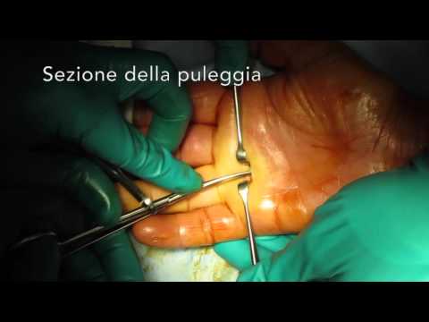 Un nervo pizzicato nellesercizio cervicale Recensioni artroplastica del gomito in