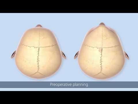 SonicWeld Rx® Surgical Technique – Craniosynostosis