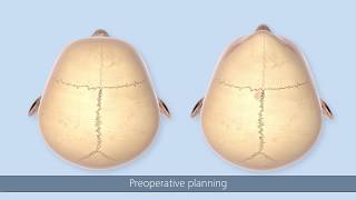 SonicWeld Rx® Surgical Technique – Craniosynostosis