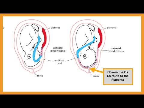 Placenta Pathology (Abruptio Placentae, Placenta Accreta/Increta/Percreta, Placenta/Vasa Previa)