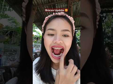 Braces Update (may kakaibang nilagay yung dentist ko)