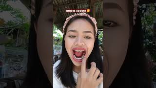 Download lagu Braces Update (may kakaibang nilagay yung dentist ko) mp3
