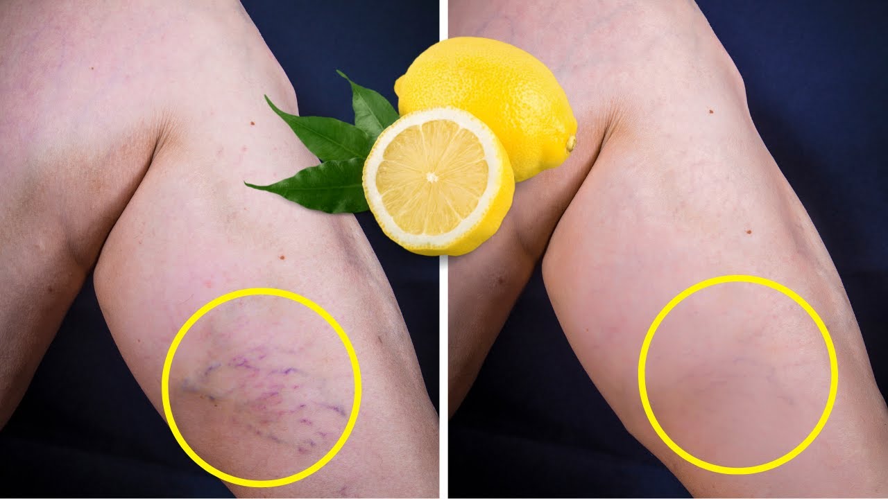 Lemon Removes Varicose Veins! Just Do This Every Day...