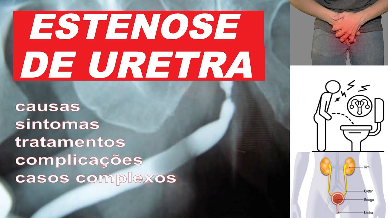 Estenose de Uretra