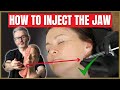 Jawline Injection Techniques | Injecting the Jaw Safely