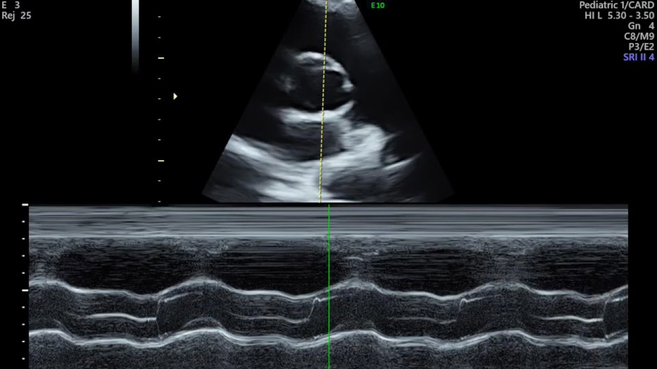 AVALIAÇÃO DE ARRITMIA CARDIACA