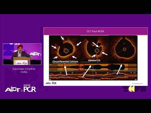 Expanding horizons in coronary calcified lesion management with intravascular lithotripsy