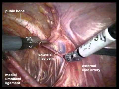 Prostate Cancer - Extended Pelvic Nodes Resection In A Robot-Assisted Laparoscopy 