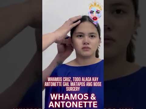 Whamos Cruz, todo alaga kay Antonette Gail matapos ang nose surgery